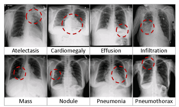 Chest X-Ray examples